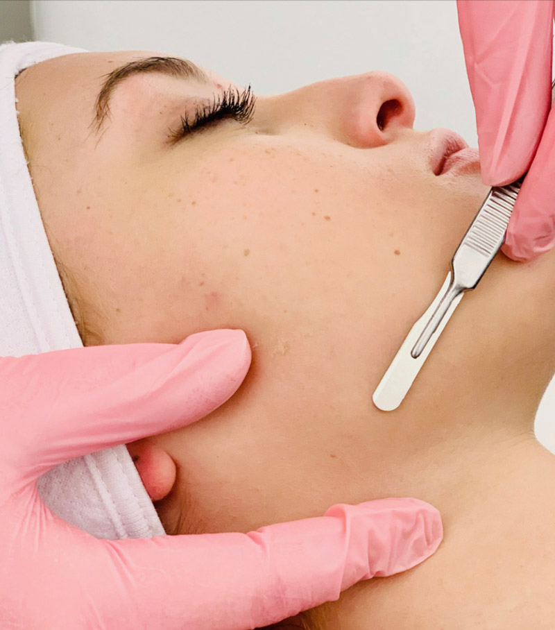 Dermaplaning treatment involves scraping away dead skin with a SCALPEL is  not for the faint-hearted